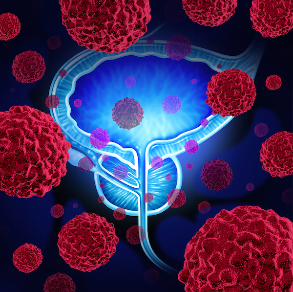 Five Types Of Prostate Cancer Found
