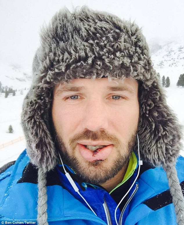 Ben Cohen Breaks Teeth After Skiing Accident